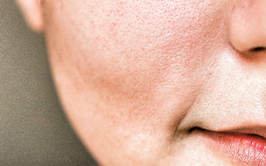 Πώς θα αντιμετωπίσετε τους διεσταλμένους πόρους στο πρόσωπο